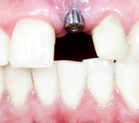 12 Dental implant Fortitude valley qld